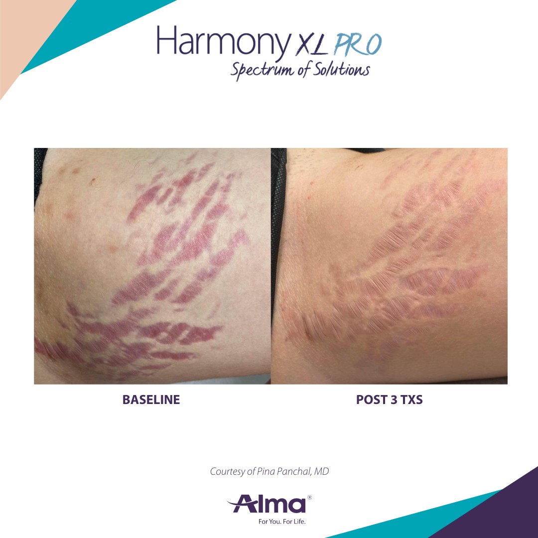 Harmony before & after