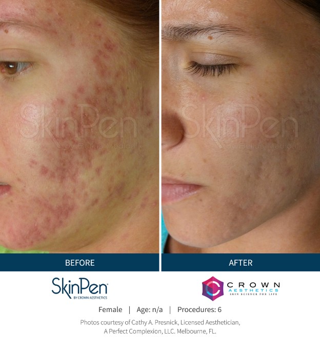 SkinPen before & after