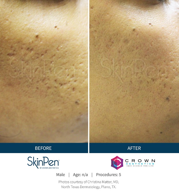 SkinPen Before & After