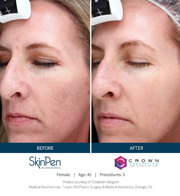 SkinPen before & after